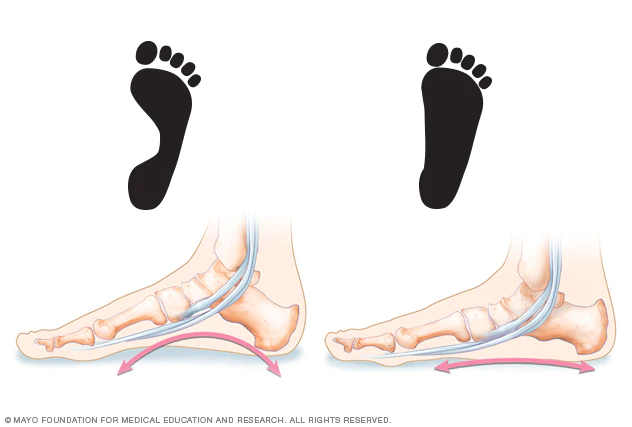 Flat feet and high arches explained in picture form